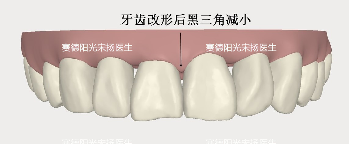 918博天堂阳光口腔宋扬医生牙齿黑三角科普图片