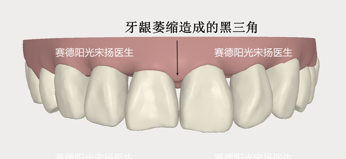 918博天堂阳光口腔宋扬医生牙齿黑三角科普图片