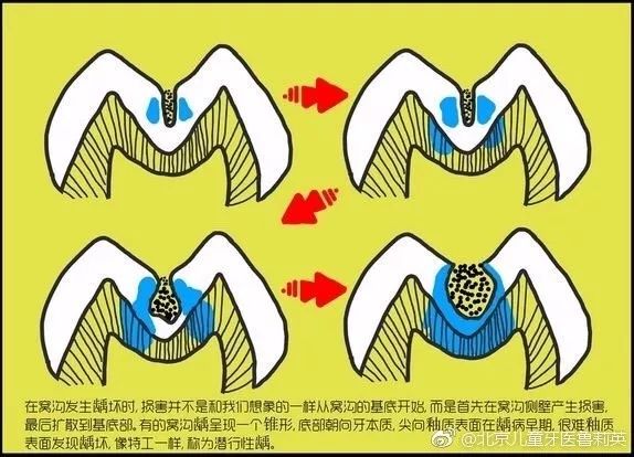 儿牙专家鲁莉英解读窝沟封闭和涂氟 918博天堂阳光口腔 北大口腔