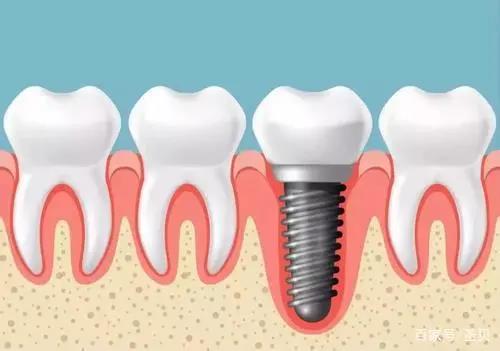 种植牙或种牙，常被人称为是人类的“第三副牙齿”：
